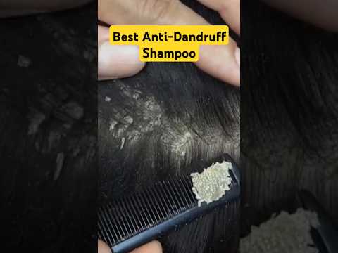 Best Anti Dandruff Shampoo for Winters #dandruff #antidandruffshampoo #shorts #DMC