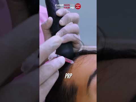 Is PRP the Ultimate Solution for Hair Fall? | Why is it so Popular? | HairMD, Pune