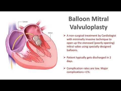 Balloon Mitral Valvuloplasty. BMV vs MVR. Rheumatic Mitral Stenosis