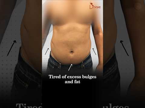 Say Goodbye to Stubborn Fat with 360° Vaser Liposuction! Abdomen Liposuction Result