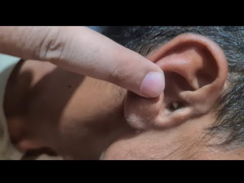 How to remove ear wax ! Child become pleased after removal of massive wax #earwax #earwaxremoval