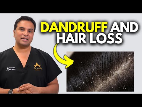 Can Dandruff Cause Hair Loss