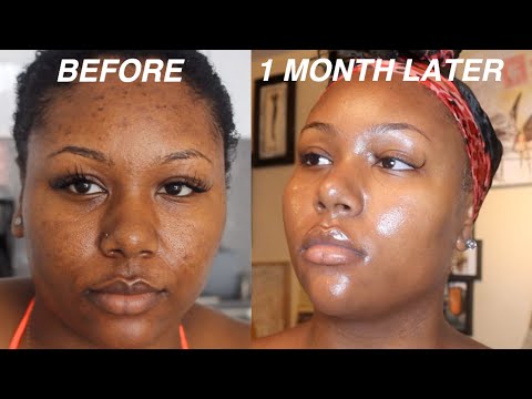 I FADED MY ACNE SCARS + GOT CLEAR SKIN DOING THIS FOR 1 MONTH! VIDEO PROOF | SKINCARE ROUTINE