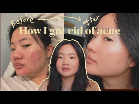 My acne skin journey | medication, routine, diet