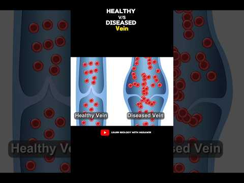 Healthy Vein v/s Diseased Vein #short