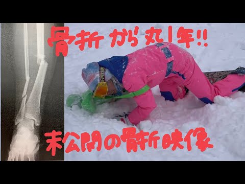 108話 骨折から丸1年【閲覧注意】