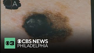 A new high tech way is helping doctors find melanoma, a form of skin cancer