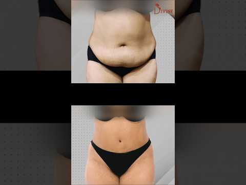 Get Your Pre-Baby Body Back with Tummy Tuck and Liposuction! #shorts