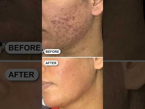 Dermaroller for acne scar and Collagen Boost at Skinaa Clinic #shorts #viral