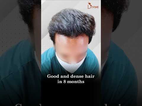 Incredible 8-Month Hair Transplant Transformation – See the Results!