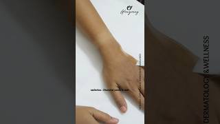 Sun tanning#chemicalpeel #skincare#haircare#sunexposure#shortvideo#shorts