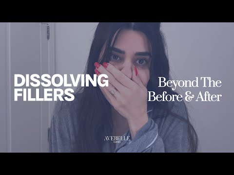 Dissolving All Filler: Here’s What Happened | Beyond the Before & After Ep. 2
