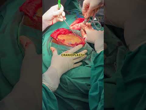 Cranioplasty- Skull placements from thigh to skull after recovery of Patient.#surgeryrecovery