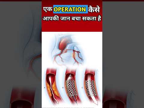 Stent heart blockage treatment in hindi| credit-@rajshamani #stent #operation #shorts