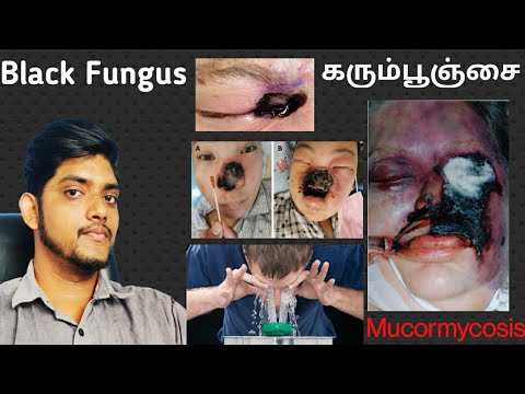 How to Prevent Black Fungus, கரும்பூஞ்சை வராமல் தடுக்க! Episode-23