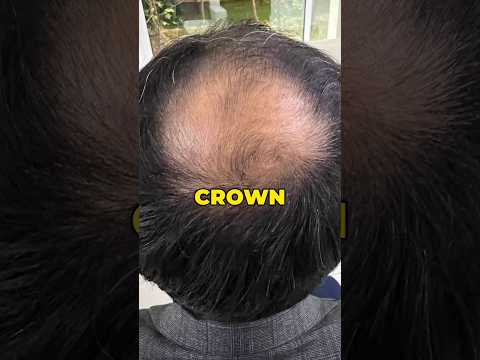 Crown & Front line Baldness Because of DHT ? #drranairfan #hairloss  #hairtransplant #shorts #fyp