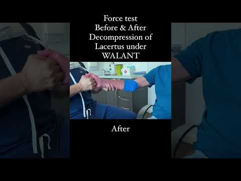 Force test Before and After Decompression of Lacertus under Walant