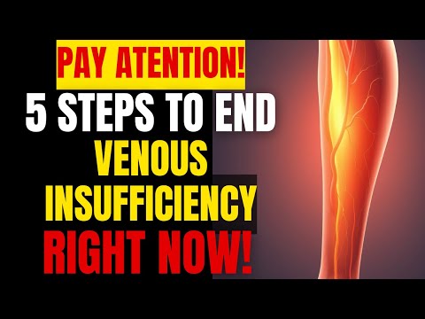 5 Steps to Relieve Venous Insufficiency Pain Once and for All After 50