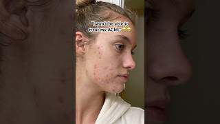 Everything is possible🫶🏻💖#acnetips #skincare #acnetreatment #acne #skintips #oilyskin #relatable