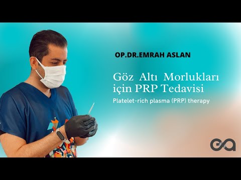 Göz Altı Morlukları için PRP Tedavisi