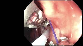 Endoscopic Sleeve Gastroplasty (ESG) in less than 3 minutes!
