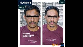 #medifacial #detanfacial #skincare #skinwhitening #skin #pigmentationfacial #cosmetic #skincare