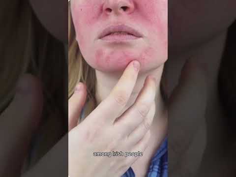Rosacea and how to treat it. #aesthetics