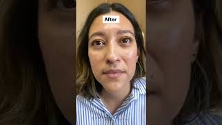 Before and After Quadfecta Lift with Dr. Kami Parsa | (Upper & Lower Blepharoplasty)