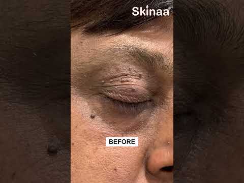 SKIN TAG REMOVAL AT SKINAA CLINIC | BEST SOLUTION FOR SKIN TAG #viralshorts  #shortsvideo