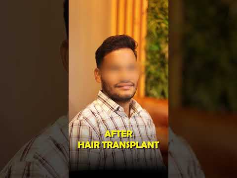 Hair Transplant: Real Before and After Results at Skinaa Clinic#Viral #shorts