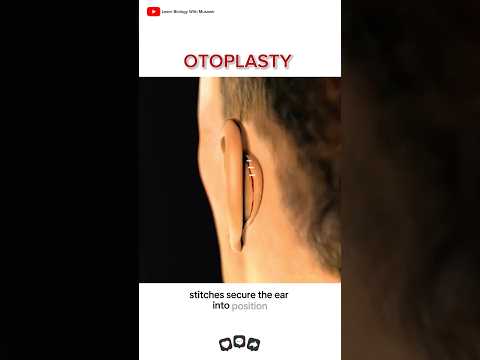 Ear reshaping surgery 👂 | Otoplasty