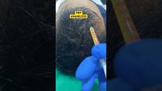 Hair Loss Treatment #hair #hairloss #hairlosstreatment #ytshorts #alopecia #hairtransplant #hairfall