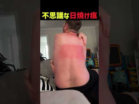 不思議な日焼け痕