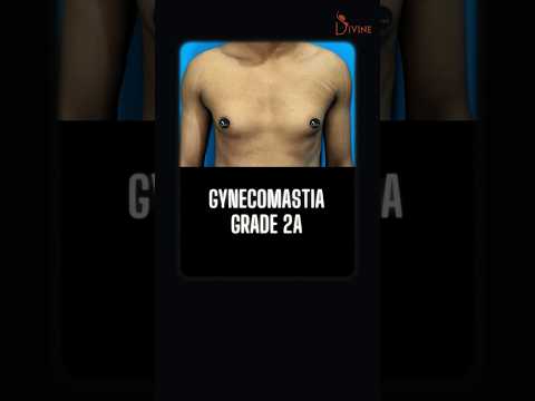 Man Boobs? Get a Sculpted Chest in Just 1 Surgery! 💪🔥 Gynecomastia  Surgery Grade 2A