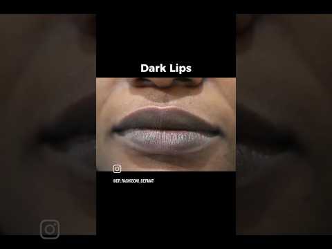 💫Dark lips 👄 problem solved, treatment under rs 100#shorts #shortvideo #short @drrashisonidermat