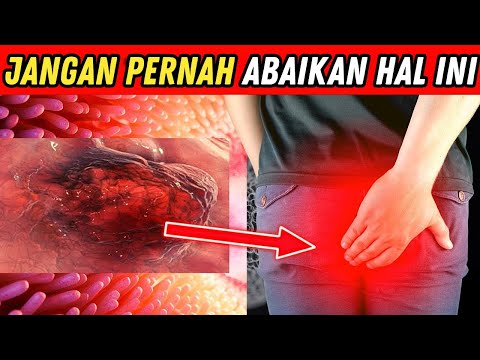 ⚠️ Gejala Kanker Usus Buntu yang Harus Diwaspadai 😱 | Cegah Sebelum Terlambat! 🩺🍎
