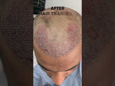 "Hair Transplant Before and After Results of a Patient at Skinaa Clinic #viral #skinaaclinic