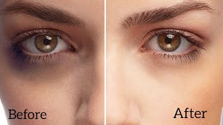How To Remove  Under Eya Dark Circle | Shammiz DIY