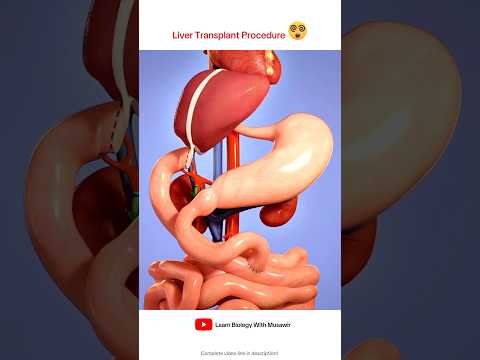 Liver transplant Procedure Animation Video