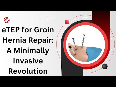 eTEP for Groin Hernia Repair: A Minimally Invasive Revolution - Insights from WALS 2025 Conference