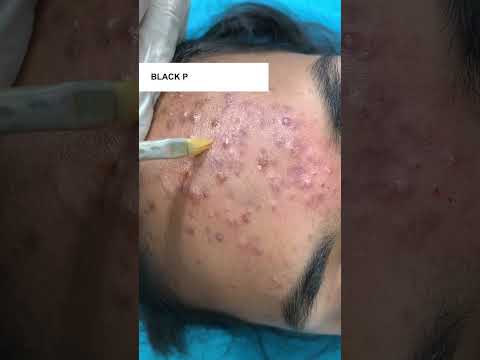 Best Black Peel on Acne Treatment at Skinaa Clinic #Viral