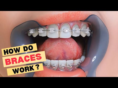 How do braces work ? #shortvideo