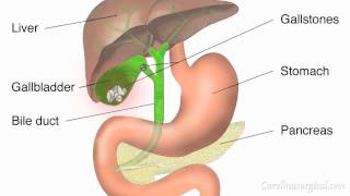Gallbladder Removal Surgery Animation