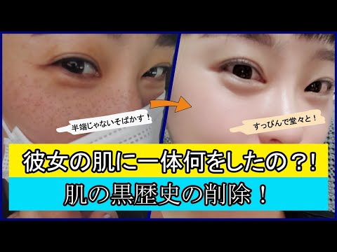 【シミ取りレーザー】シミそばかすがコンプレックスだった彼女 🤦‍♀️、彼女の肌に一体何を？ 👀👀