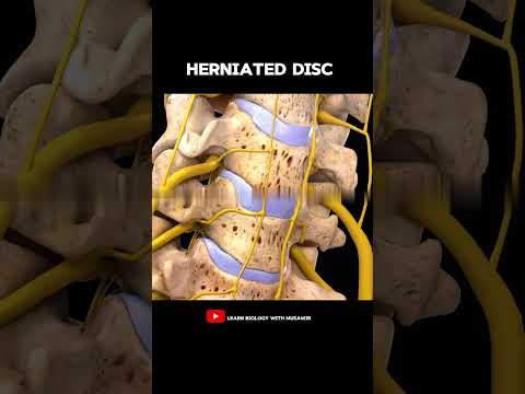 Spine model | Herniated disc | Anatomy