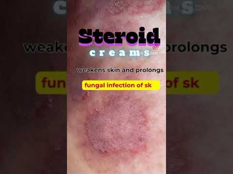 fungal infection I athletes foot I skincare I fungal nail I ring worm