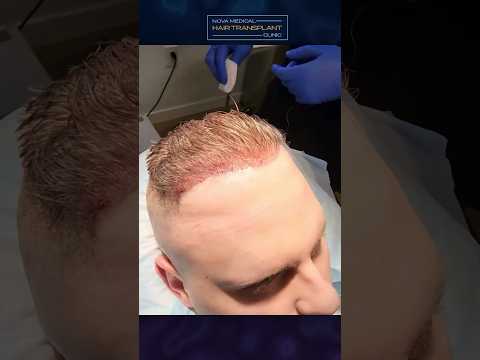 😍Witness This Hairline Transformation / #fuehairtransplant #hairsurgery #hairtransplants