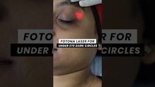Fotona Laser for Under eye Dark Circles | ClearSkin Pune