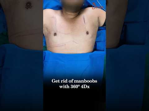 Male Breast Reduction Grade 3A Before and After |  360° 4Dx Gynecomastia #short