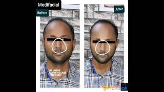 #medifacial #detanning #detanfacial #cosmetic #skinwhitening #skinlightening #cosmetic #skincare